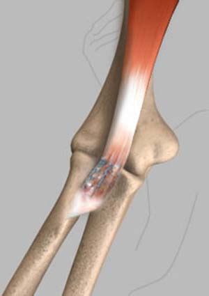 Distal Biceps Tendon Repair Arlington, TX | Biceps Tendon Rupture Frisco, TX