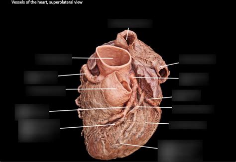 cadaver heart Diagram | Quizlet