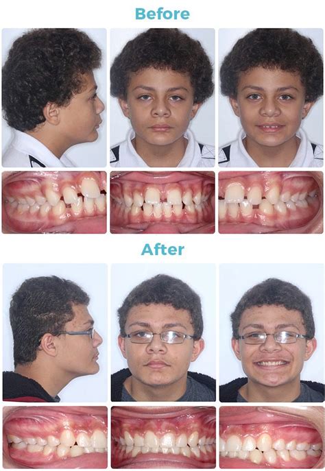 Before and After Orthodontic Treatment Photos | David Ross Ortho