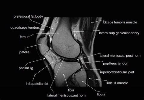 MRI anatomy of the knee | Knee mri, Mri, Knee doctor