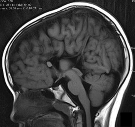 Agenesis of corpus callosum – Radiology Cases