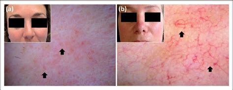 Dermoscopy in the differential diagnosis between malar rash of systemic lupus erythematosus and ...