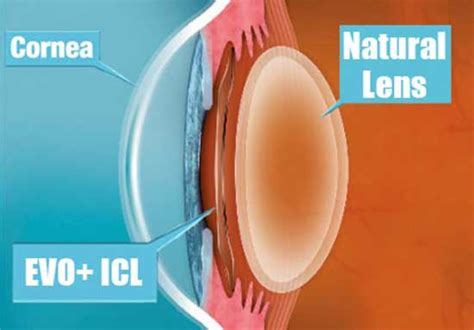 Permanent Contact Lenses | Implantable Contact Lenses