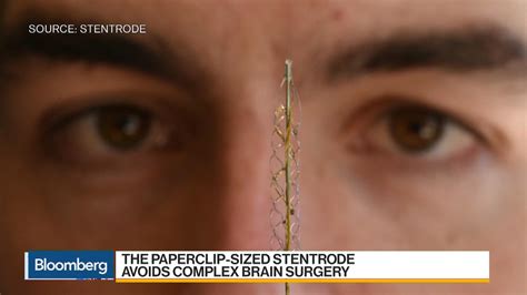 Watch The Brain Implant That Could Defeat Paralysis - Bloomberg