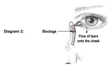 Endoscopic Dacrocystorhinostomy (DCR) (Surgery for a watery eye) - Milton Keynes University Hospital