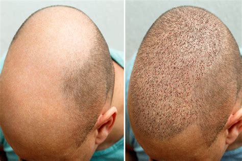 DHI Hair Transplant Before And After | Harley Street Healthcare