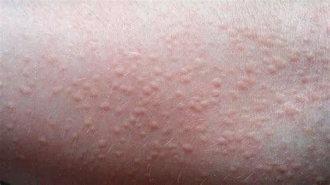 Why Is My Face Itchy With Little Bumps | Allergy Trigger