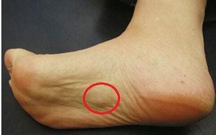 Lumpy Bumpy Foot: Paul Betschart, DPM: Podiatrist