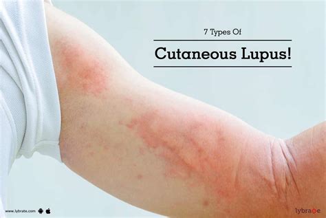 7 Types Of Cutaneous Lupus! - By Dr. Yogesh | Lybrate