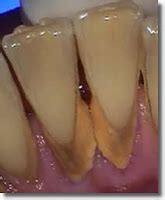 Teeth And Dental Care: Plaque, Tartar (Dental Calculus), Prevention And ...