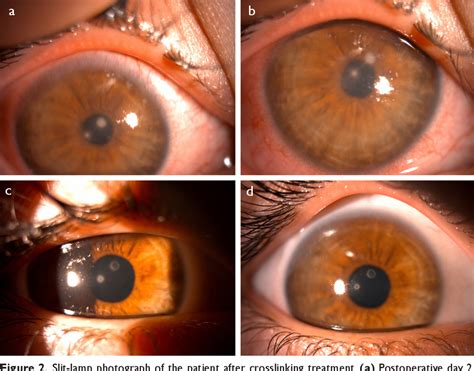 Figure 2 from Sterile Corneal Infiltrate Management After Corneal ...