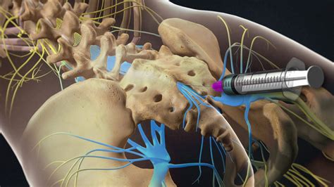 Interventional Pain Center Services - SASpine Surgical Associates in Spine