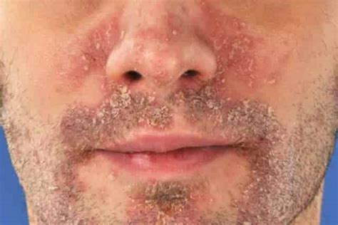 Psoriasis Skin Rash On Face