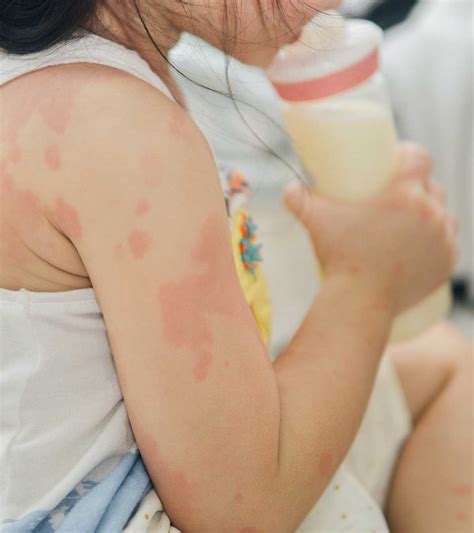 6 Important Signs And Causes Of Milk Allergy In Children