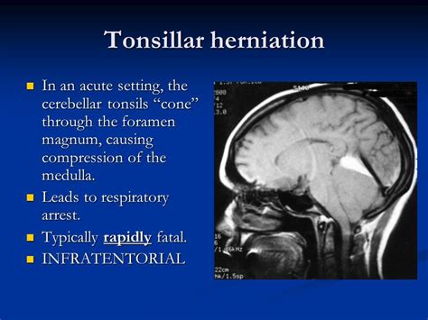 Image result for tonsillar herniation | Image, Respiratory, Anatomy