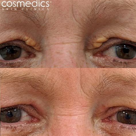 Xanthelasma Eyelid Cholesterol Treatment | Cosmedics Skin Clinics