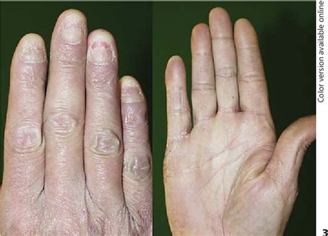 Figure 1 from Acrodermatitis Continua of Hallopeau Treated Successfully with Ustekinumab and ...