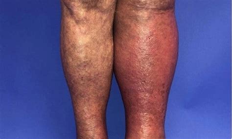 Cellulitis | NHS inform