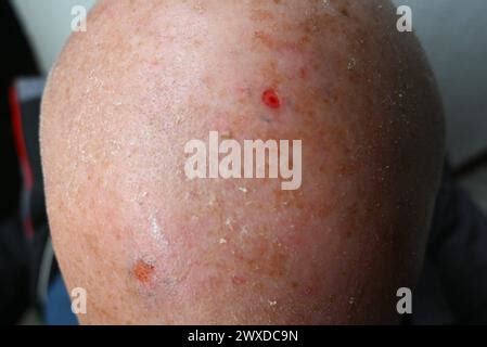 Vorbeugung, Weißer Hautkrebs. Nach der Laser-Behandlung beim Hautarzt bzw der Dermatologie: Die ...