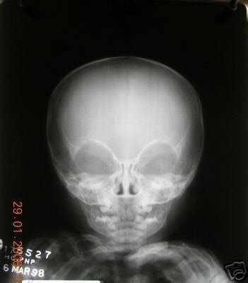 Human BABY SKULL x-ray real negative 10X12 | #36935152