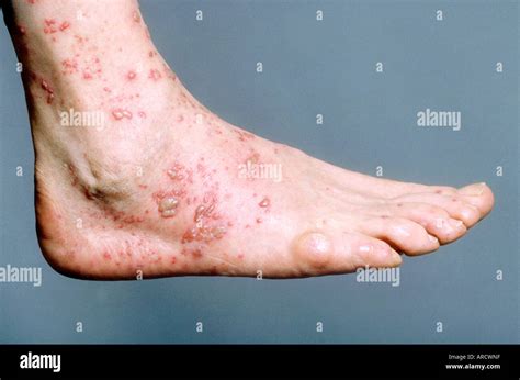 Shingles lesions on foot hi-res stock photography and images - Alamy