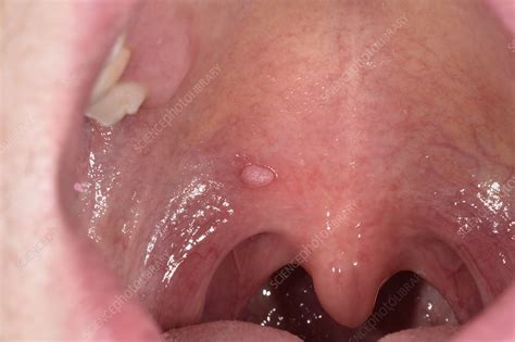 Hpv Warts Lips Pictures | Lipstutorial.org