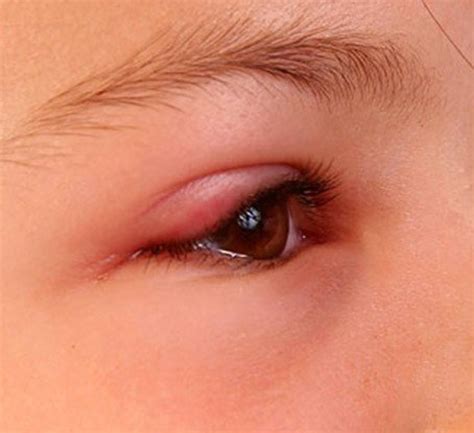 Swollen Eyelid - Symptoms, Treatment, Pictures, Causes | HealDove