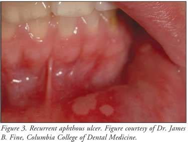 Treatment of Common Oral Lesions