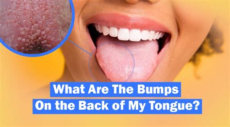 Are Bumps On Back of Tongue Normal? What Could Be Happening