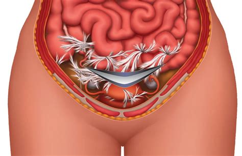 Internal Abdominal Scar Tissue Symptoms