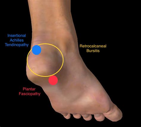 Bike Radar: Back Of Heel Pain Running