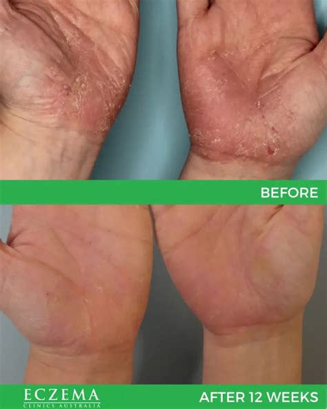 Eczema before & afters - Dermatology Clinics Australia