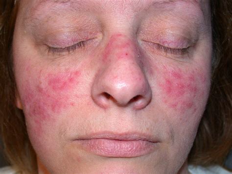 Acne Rosacea - Causes, Symptoms, Treatment, Pictures, Diet | Diseases Pictures