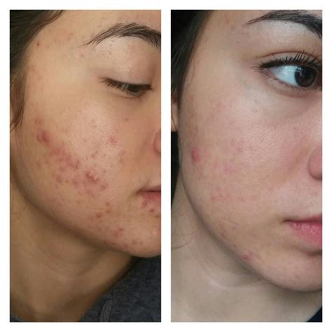 My Experience with Tazorac so far - Personal logs - Acne.org