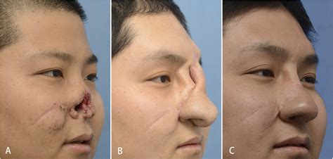 Nasal reconstruction with the expanded forehead flap: Long-term follow-up of esthetic outcome ...