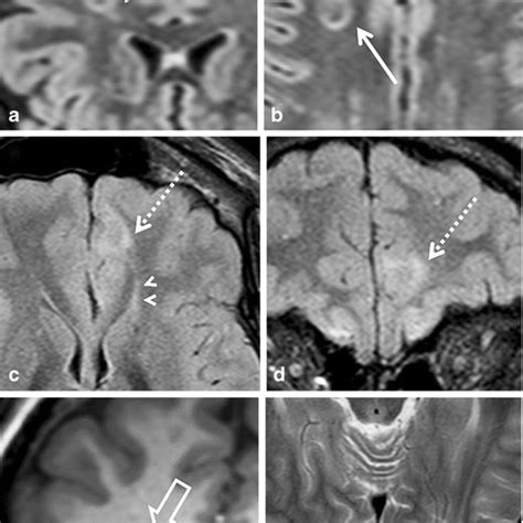 A 9-year-old girl with temporal lobe epilepsy with MRI findings ...