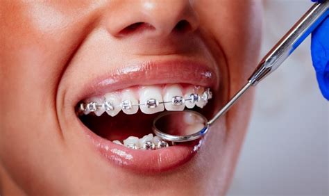 Teeth Whitening with Braces: What You Need To Know