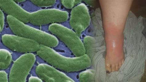 Woman tests positive for Vibrio Vulnificus in Baldwin County