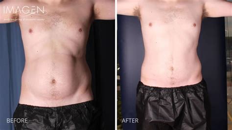 Liposuction in Omaha, NE - Omaha Liposuction by Imagen