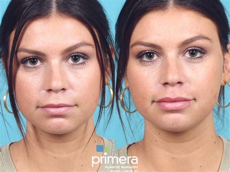 JUVÉDERM® Before and After Pictures Case 802 | Orlando, Florida | Primera Plastic Surgery