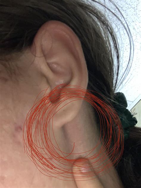 Lump under earlobe I can feel, painless. : r/medical