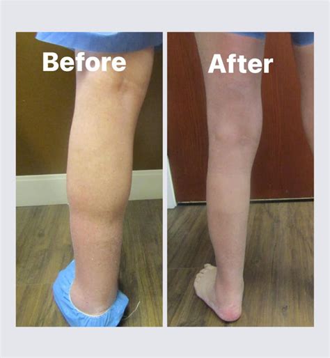 Lymphedema in Omaha, NE | Venus Vein Clinic