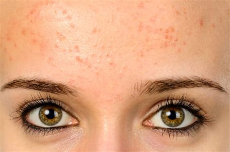 How To Treat Fungal Face Acne Be Beautiful India - Riset