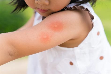 Bug Bites That Need Medical Attention—Now | Reader's Digest