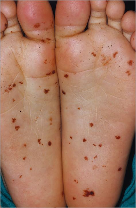 Cydnidae (Burrowing Bug) Pigmentation: A Novel Arthropod Dermatosis | Dermatology | JAMA ...