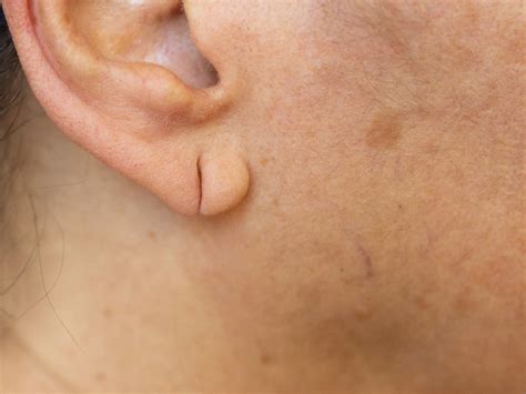 Ear Lobe Repair Reconstruction | GMC Cosmedical