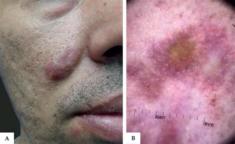 SciELO - Brasil - Dermoscopy of granuloma faciale: a description of a new finding Dermoscopy of ...