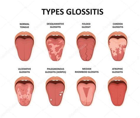 Types glossitis. Tongue disease illustration — Stock Vector ...