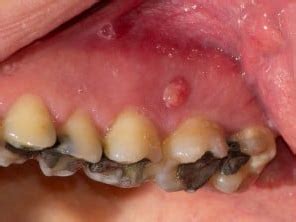 Pimple on Gums - Pictures, Causes, Prevention & Home Remedy (2023)