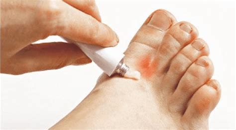 Treating Tinea Pedis: A Comprehensive Guide to Antifungal Medicines for External Use - Archyde